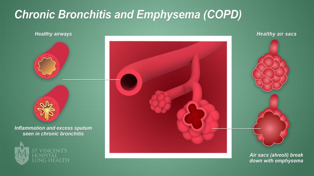 1 SVH Lung Health Bronchitis final 1080p