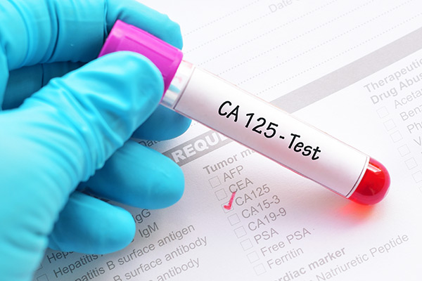 cs CA125 building better biomarker ovarian cancer screening 600x400 1